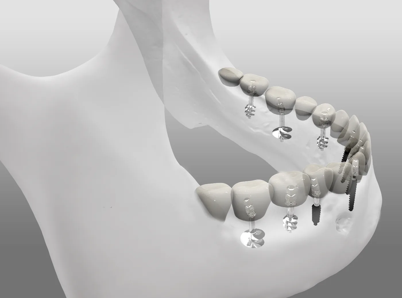 One-piece implants restored in the mandible