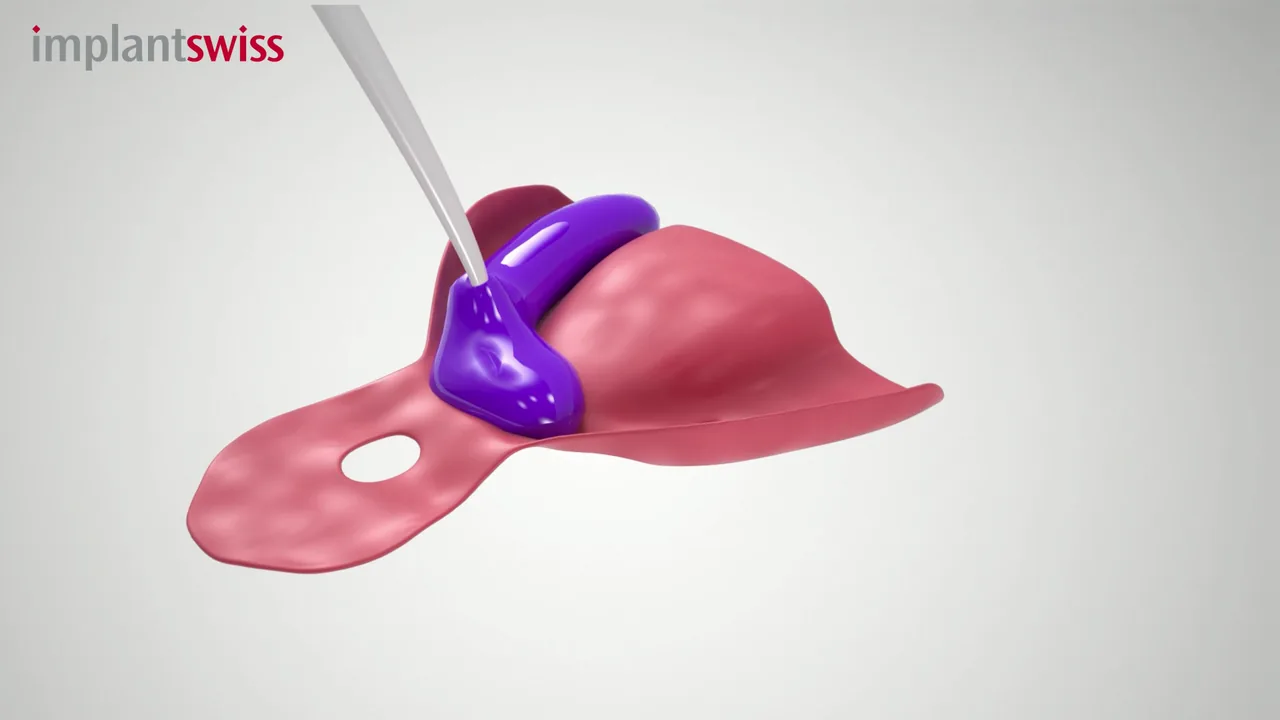 Multi-unit impression coping pick-up shown on a digital model
